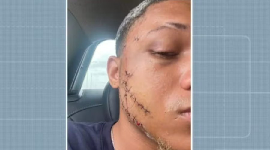 [Jovem leva 37 pontos no rosto após ser agredido com garrafa de vidro ao separar briga em saída de festa na Bahia]