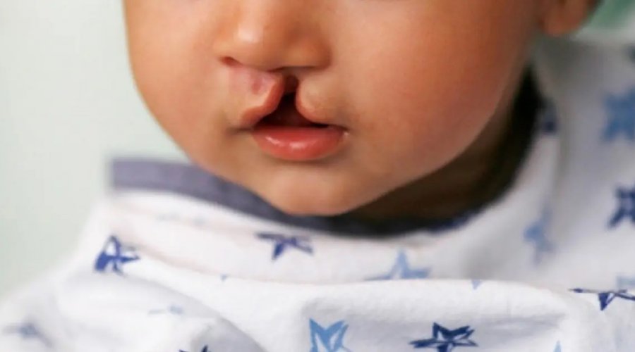 [Cirurgias para correção de lábio leporino aumentam mais de 40% em Salvador nos últimos três anos]