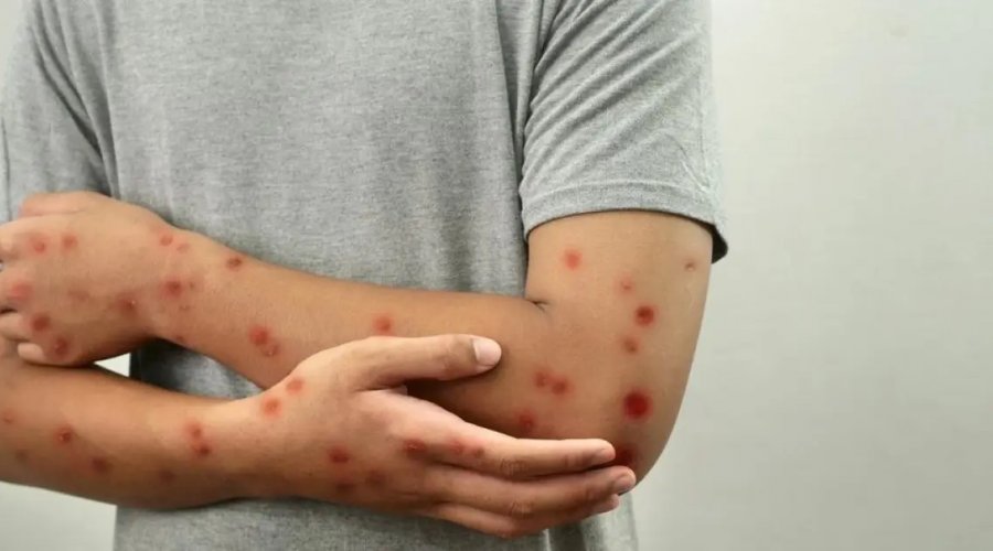 [OMS mantém mpox como emergência global de saúde pública]