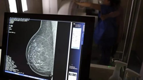 [Ministério da Saúde amplia acesso a mamografia preventiva a partir dos 40 anos]