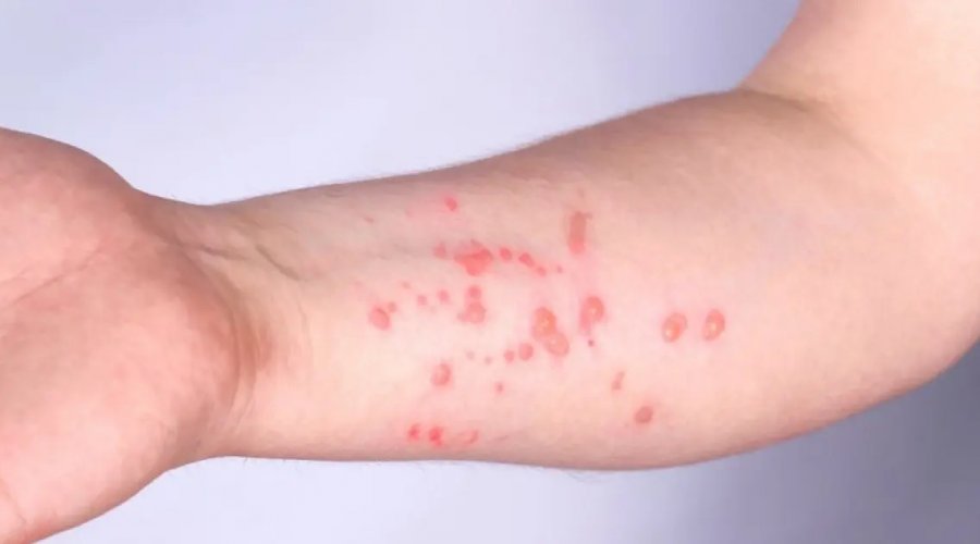 [Porto Alegre confirma novo caso de Mpox registrado durante o Carnaval]